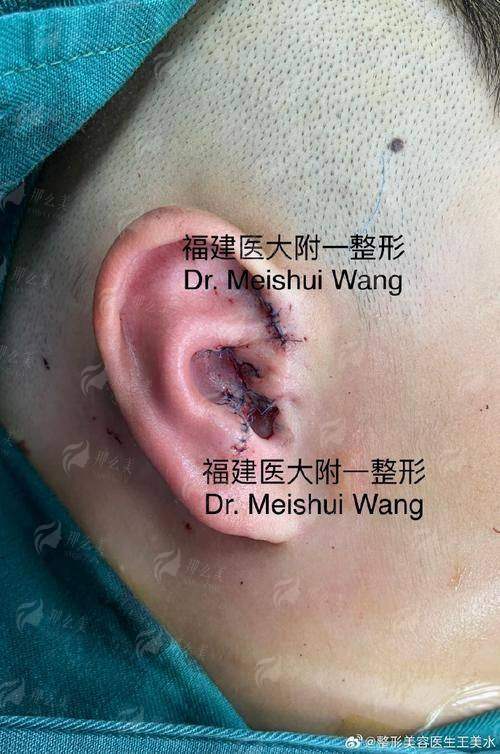 二、成都米兰柏羽的耳再造项目怎么样？