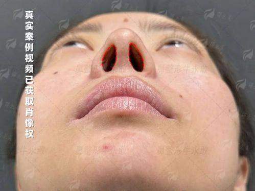 二、西安叶子医疗美容医院的朱健康院长鼻修复有哪些特色与支持？