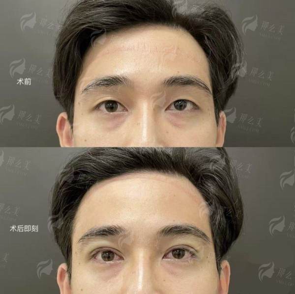 四、浙江杭州整形医院的杨甄宇提升双眼皮如何选择与预约？