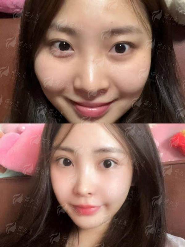 一、江西景德镇华瑞医疗的双眼皮手术有什么特色?