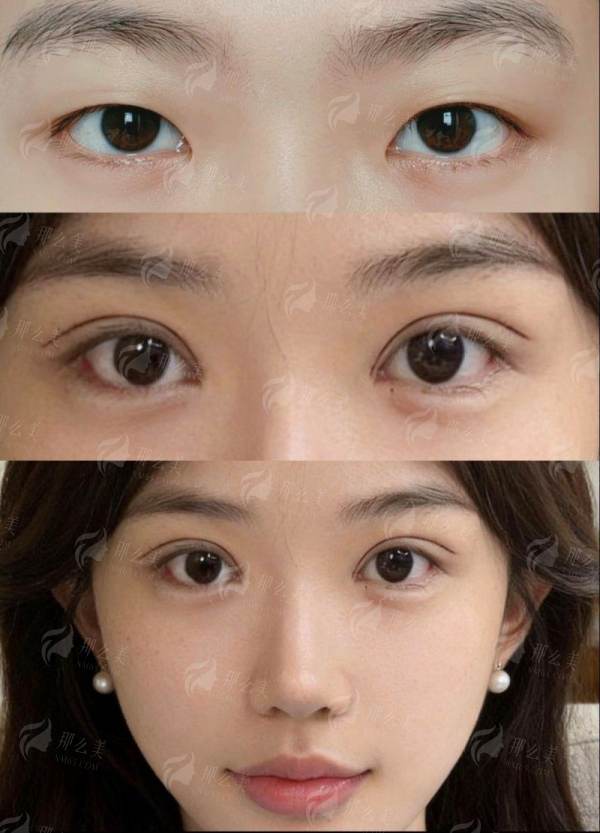 三、浙江杭州整形医院的杨甄宇提升双眼皮价格与流程是怎样的？