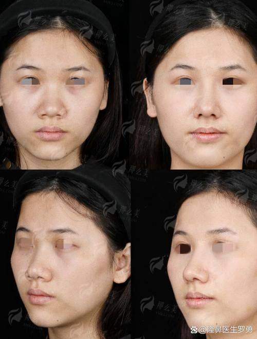 三、选择广州曙光做程鹏隆鼻,服务和体验如何?