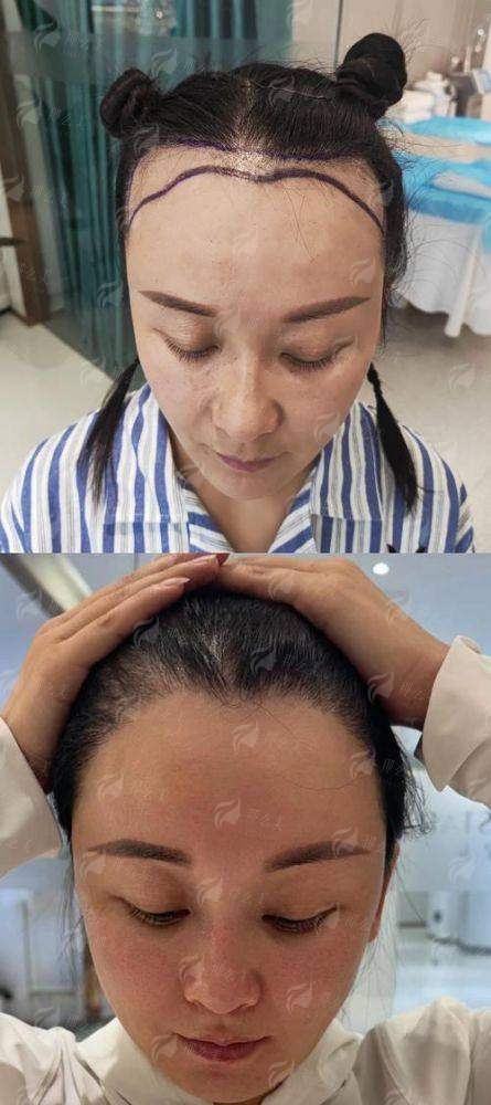 三、在桂林华美做发际线种植的流程和价格是怎样的?