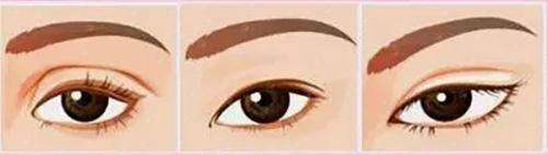 二、贺洁双眼皮修复的技术优势，到底强在哪里？