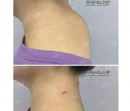 西安国际医学中心医院叶桐江主任做富贵包怎么样？技术特色与预约方式详解