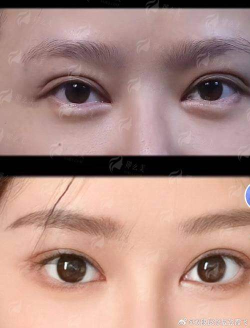 三、上海华美与上海艺星的眼修复有什么优势？