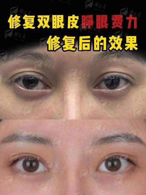 二、上海美莱眼修复技术好吗？综合体系下的精专选择