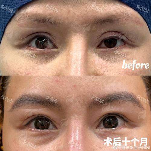 一、上海伯思立眼修复怎么样？专注高难度修复的“技术派”