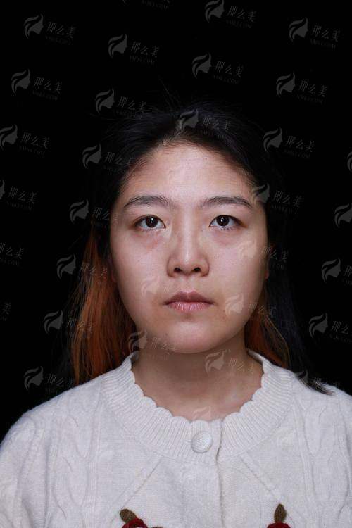 三、在江西景德镇华瑞医疗做眼袋治疗的价格与流程是怎样的？