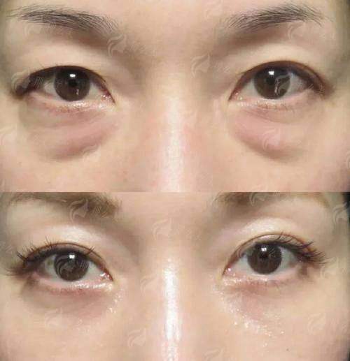 景德镇华瑞医疗眼袋手术怎么样？特色技术解析与真实案例推荐