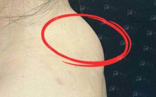 四、如何理性选择西安国际医学中心医院叶桐江富贵包治疗？