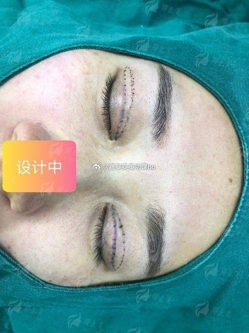 三、贺洁双眼皮修复的价格与实例，如何理性看待？