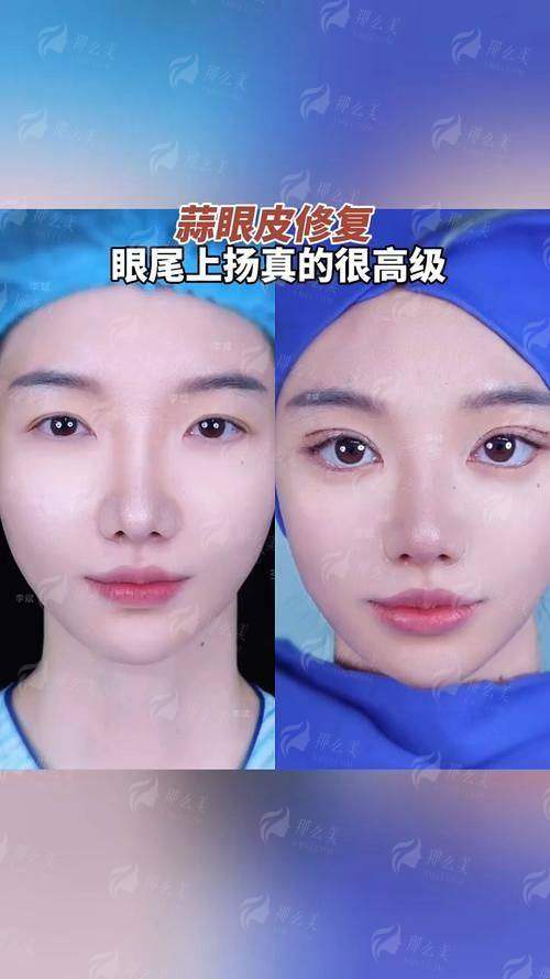 四、在郑州东方整形进行贺洁双眼皮修复，流程与体验如何？