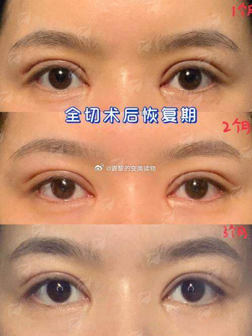 一、石家庄天宏医疗美容医院的张学雷医生，做双眼皮有啥独到之处？