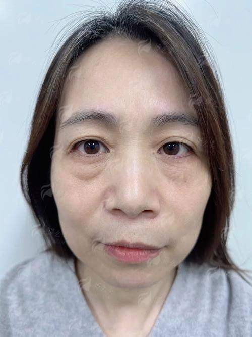 二、在秦皇岛纪辉美容医院做眼袋，怎么预约訾海涛医生？