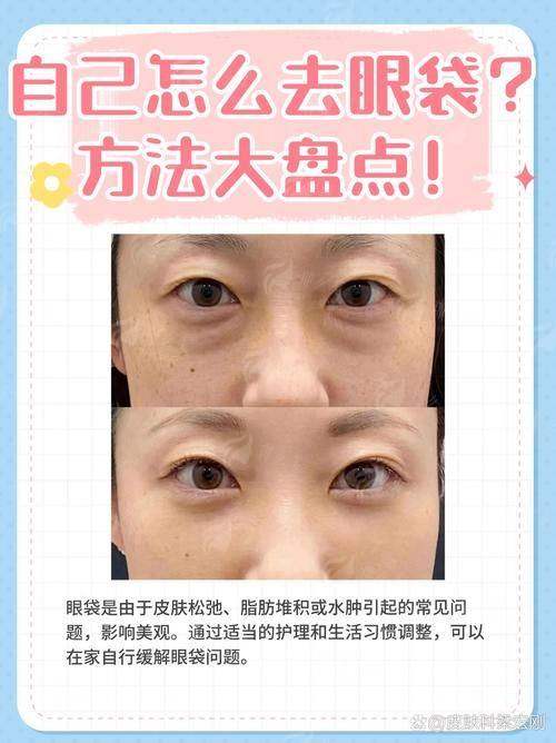 四、在秦皇岛做眼袋，除了纪辉美容医院还有别的选择吗？