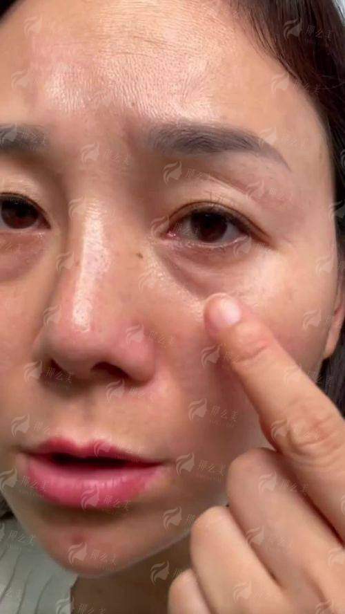 一、秦皇岛纪辉美容医院的訾海涛医生，做眼袋到底行不行？