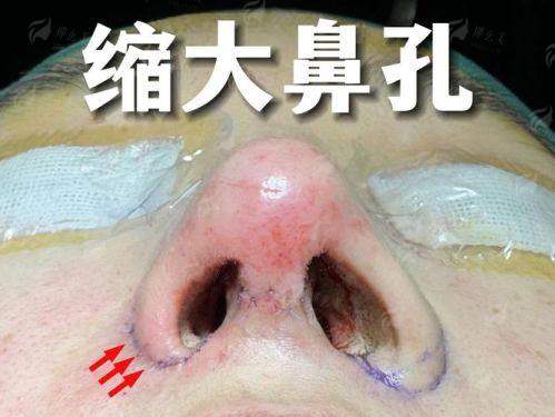 三、北京地区鼻翼缩小项目价格与选择对比