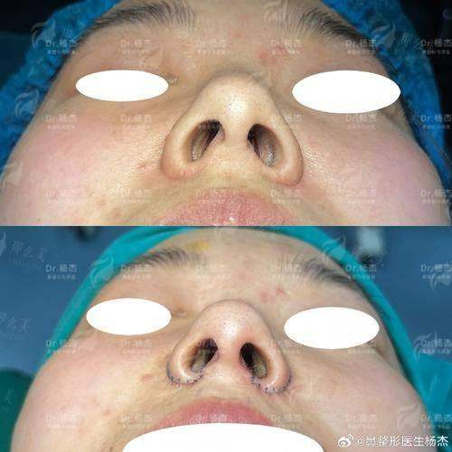 四、关于宫国华鼻翼缩小，美亲们还需要知道这些