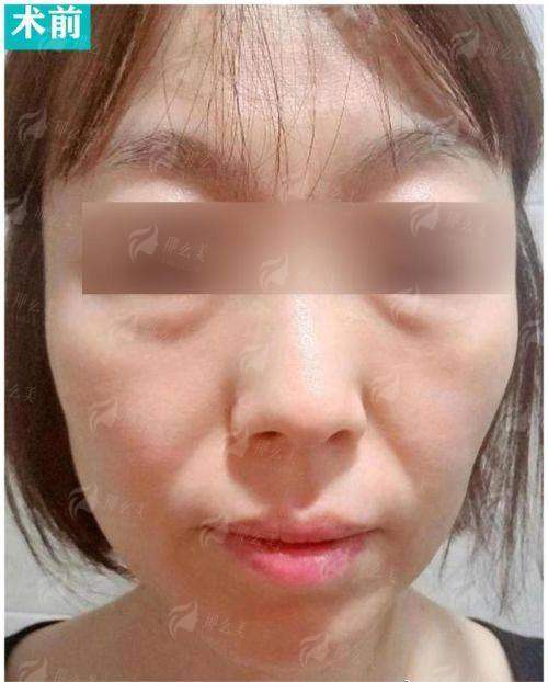 三、在兰州做拉皮，价格和修复期是怎样的？