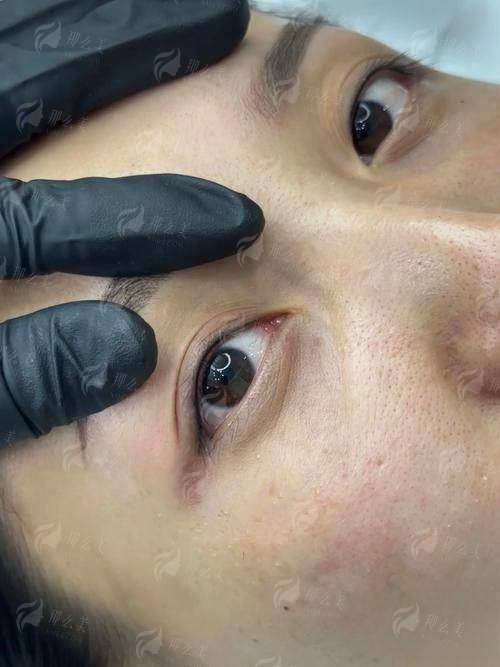 三、在绵阳宜宾丝缘植发做睫毛种植的价格和流程是怎样的？