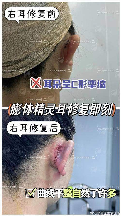 二、在广州壹加壹整形美容医院找陈星帆医生做“精灵耳”，有哪些特色方式？