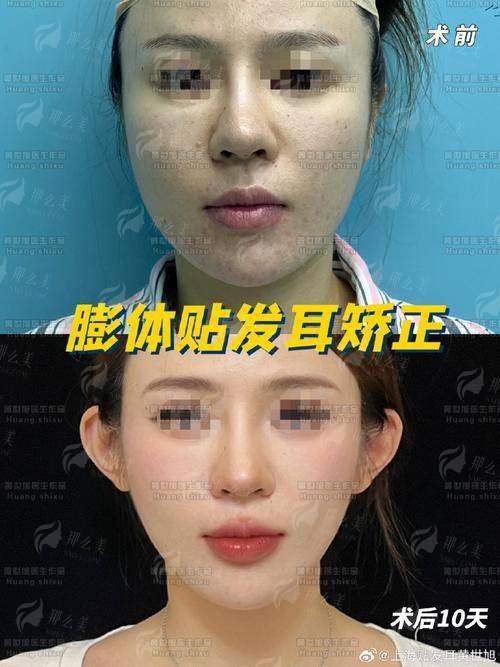 一、陈星帆医生在广州壹加壹整形美容医院如何解读“精灵耳”美学？