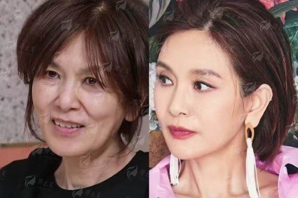 三、在武汉美丽力量医疗美容做石红卫拉皮，如何预约与费用是多少？