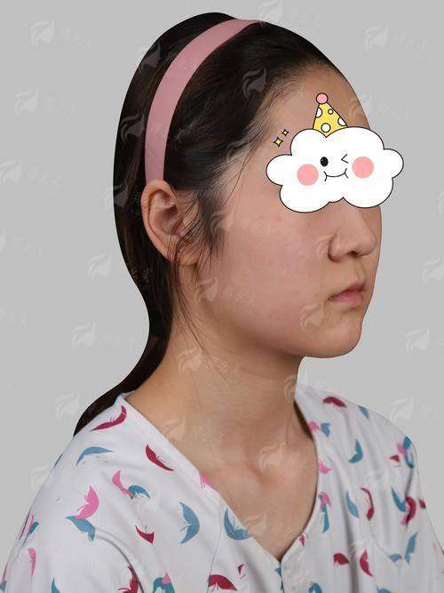 四、益阳明瑞整形隆鼻该如何选择与总结推荐？