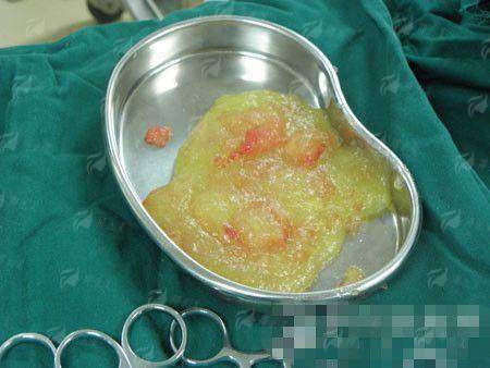 三、在汕头汕美整形做隆胸，价格和流程是怎样的？