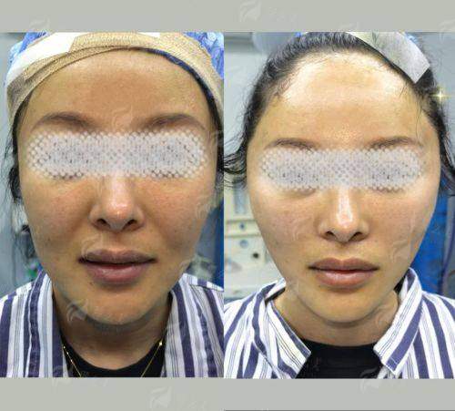 二、北京蒂凡妮医疗美容医院的王志坚拉皮手术术后结果如何？