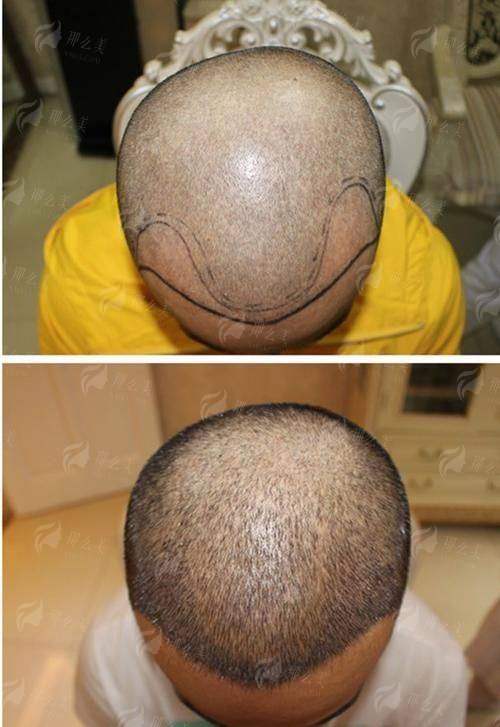 二、安徽合肥曙光植发的流程与成效保护如何？