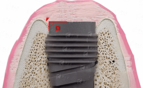 <strong>三、 治疗实例与患者反馈</strong>