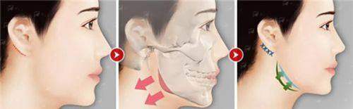 <strong>二、成都八大处俞冰医生核心技术手法揭秘</strong>