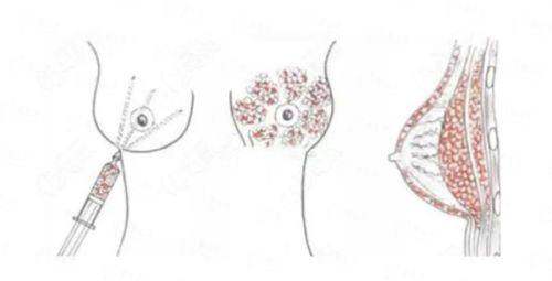 三、成都八大处医疗美容医院马晓阳双眼皮真实实例分享