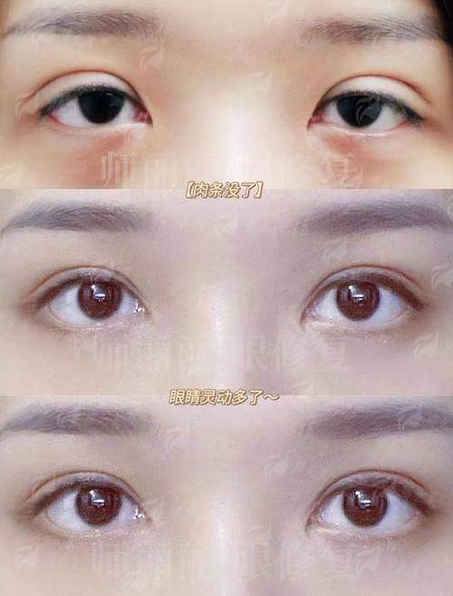 四、在衡水做双眼皮，如何科学选择与更终预约？