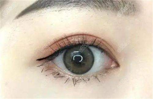 三、衡水市天宏医疗美容的双眼皮项目性价比如何？