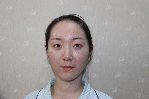 二、北京眼修复好医生张冰洁，她如何处理复杂的眼角与形态问题？