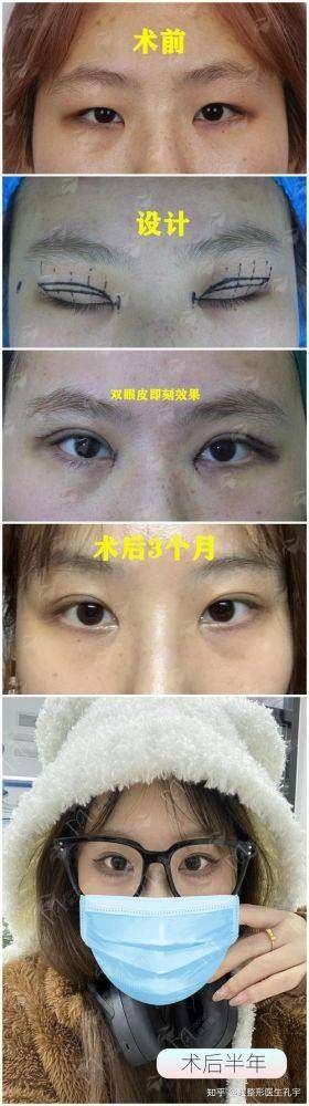 一、衡水韩娅整形美容的双眼皮技术有何独到之处？