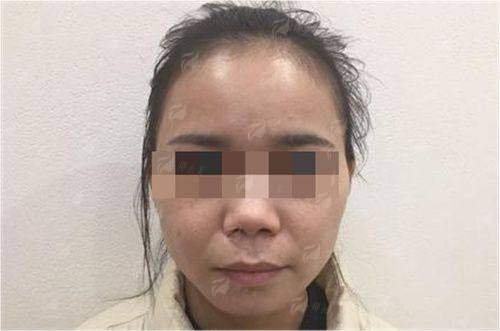 四、如何预约湖南常德美莱整形的伊妍仕少女针面诊?