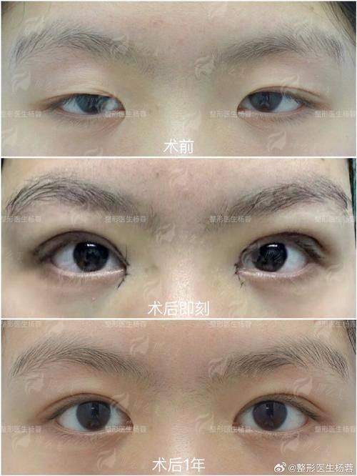 二、湖北恩施天后整形医院的埋线双眼皮技术好吗？