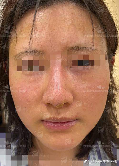 三、在武汉同济医学院医院做肋骨鼻,如何预约与面诊?