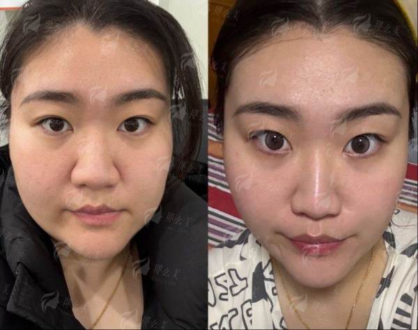 一、武汉同济医学院医院的肋骨鼻技术实力如何?