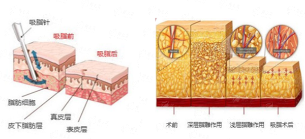 苏州美贝尔线雕技术特色解析，附医院介绍与到院路线指引