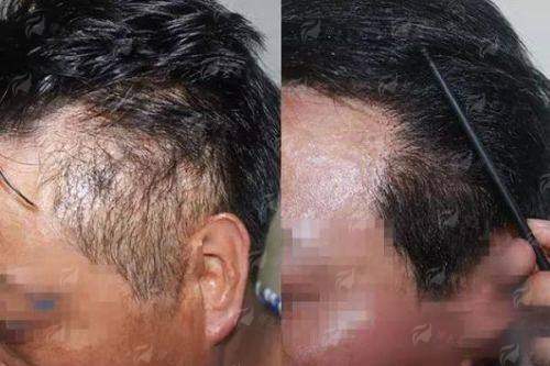 四、如何预约南昌国丹植发的微针植发面诊？