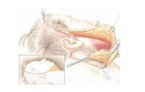 二、东莞美立方医美医院做大腿吸脂的骨干医生和仪器靠谱吗？