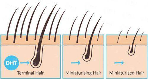 三、南昌地区微针植发的价格与对比，国丹植发有何优势？