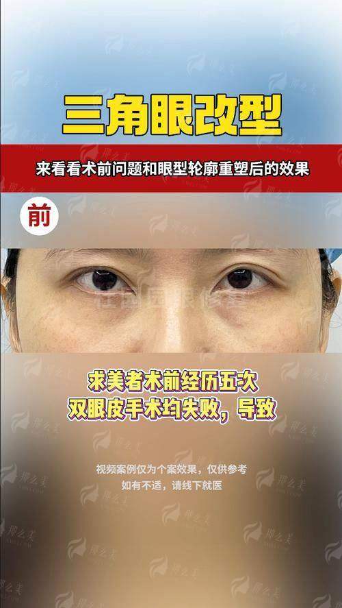 王衡健医生眼修复真实测评：技术、价格、预约方式（新颜智尚小程序）一览