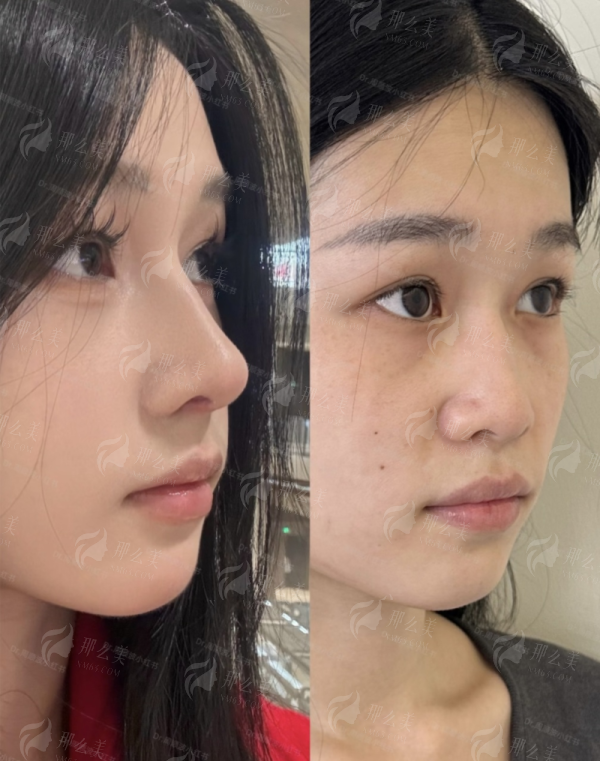 三、在东莞美立方医美医院做大腿吸脂要花多少钱？