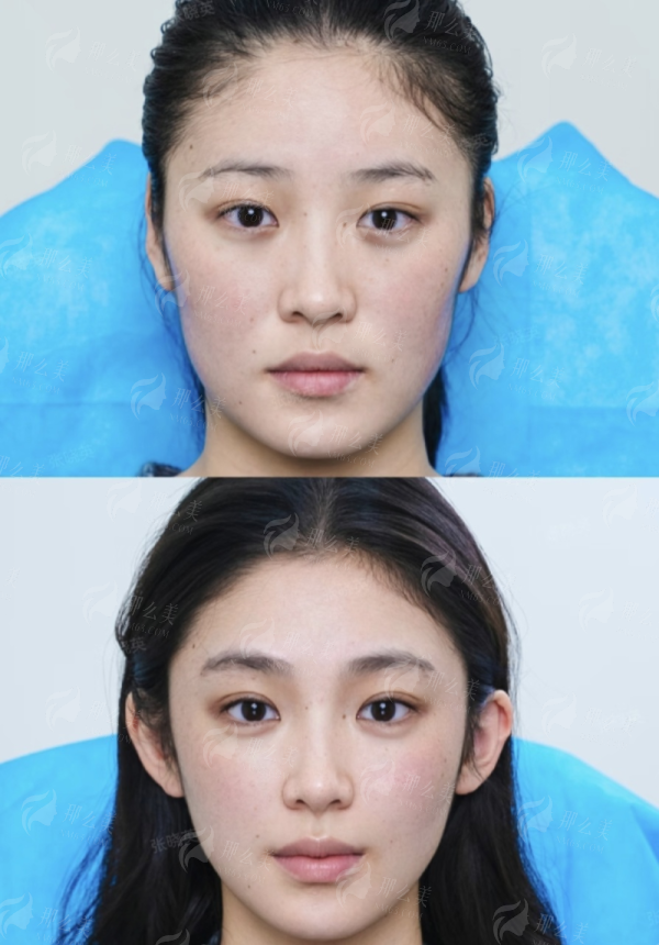 <strong>三、选择广州曙光刘杰伟隆鼻，需要注意什么？</strong>